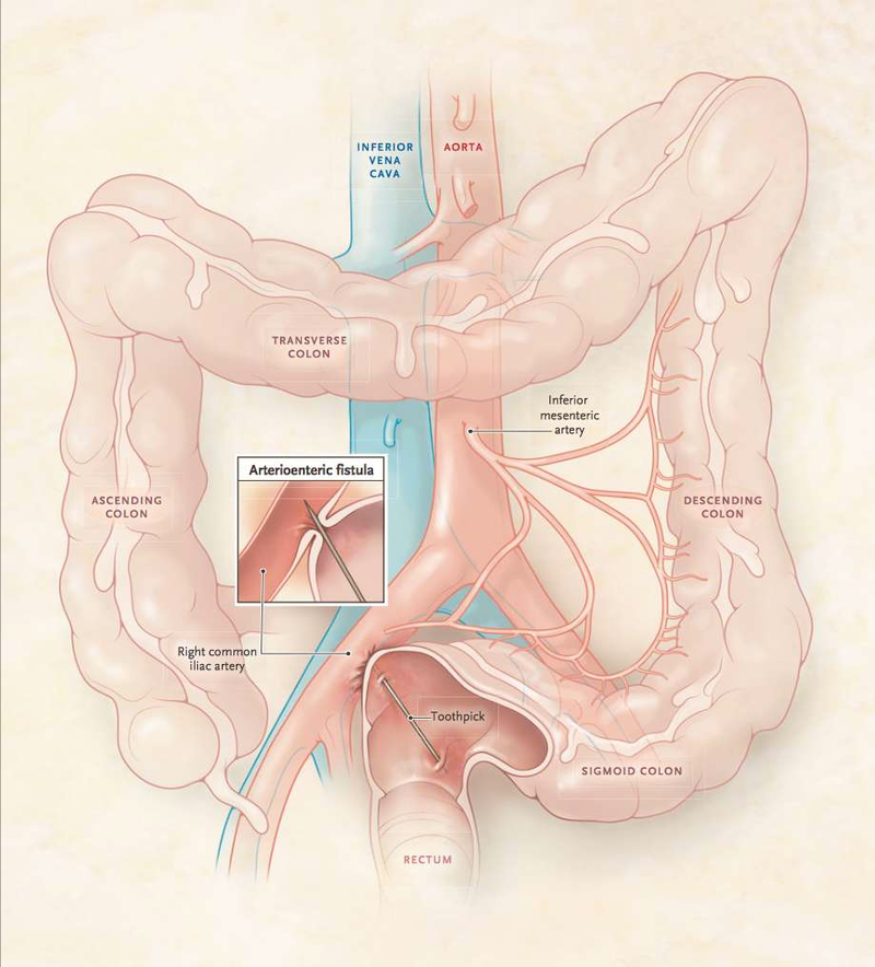 Illustration for article titled Esto es lo que pasa en el interior del cuerpo si te tragas un palillo de dientes y los médicos no lo encuentran durante tres semanas
